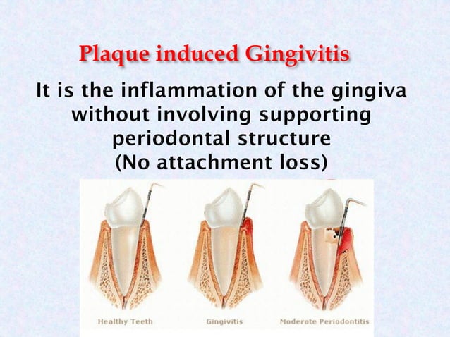 2- Gingivitis and periodontitis.pdf