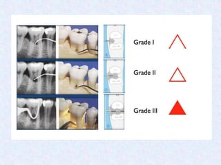 2- Gingivitis and periodontitis.pdf