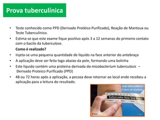 • Teste conhecido como PPD (Derivado Protéico Purificado), Reação de Mantoux ou
Teste Tuberculínico.
• Estima-se que este exame fique positivo após 3 a 12 semanas do primeiro contato
com o bacilo da tuberculose.
Como é realizado?
• Injeta-se uma pequena quantidade de líquido na face anterior do antebraço
• A aplicação deve ser feita logo abaixo da pele, formando uma bolinha
• Este líquido contém uma proteína derivada do micobacterium tuberculosis –
Derivado Proteico Purificado (PPD)
• 48 ou 72 horas após a aplicação, a pessoa deve retornar ao local onde recebeu a
aplicação para a leitura do resultado.
Prova tuberculínica
 