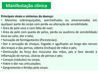 Manifestação clínica
Principais sinais e sintomas da doença:
• Manchas esbranquiçadas, avermelhadas ou amarronzadas em
qualquer parte do corpo com perda ou alteração de sensibilidade;
• Área de pele seca e com falta de suor;
• Área da pele com queda de pelos, perda ou ausência de sensibilidade
local ao calor, dor e tato;
• Sensação de formigamento (Parestesias);
• Dor e sensação de choque, fisgadas e agulhadas ao longo dos nervos
dos braços e das pernas, edema (inchaço) de mãos e pés;
• Diminuição da força dos músculos das mãos, pés e face devido à
inflamação de nervos, úlceras de pernas e pés;
• Caroços (nódulos) no corpo;
• Febre e dor nas articulações;
• Sangramento e feridas pelo corpo.
 
