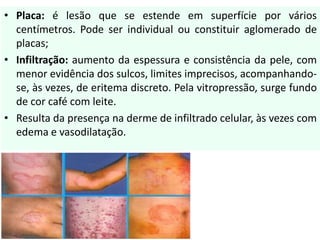 • Placa: é lesão que se estende em superfície por vários
centímetros. Pode ser individual ou constituir aglomerado de
placas;
• Infiltração: aumento da espessura e consistência da pele, com
menor evidência dos sulcos, limites imprecisos, acompanhando-
se, às vezes, de eritema discreto. Pela vitropressão, surge fundo
de cor café com leite.
• Resulta da presença na derme de infiltrado celular, às vezes com
edema e vasodilatação.
 