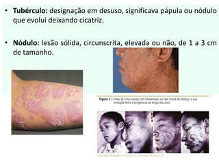 • Tubérculo: designação em desuso, significava pápula ou nódulo
que evolui deixando cicatriz.
• Nódulo: lesão sólida, circunscrita, elevada ou não, de 1 a 3 cm
de tamanho.
 