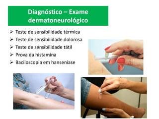  Teste de sensibilidade térmica
 Teste de sensibilidade dolorosa
 Teste de sensibilidade tátil
 Prova da histamina
 Baciloscopia em hanseníase
Diagnóstico – Exame
dermatoneurológico
 
