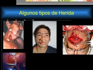 Algunos tipos de Herida 
