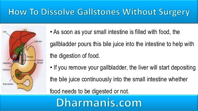 Gallstones Treatment Natural Cure Gallstones Treatment Natural Cure