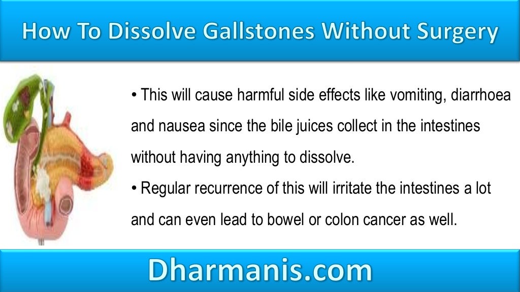 How To Naturally Dissolve Gallstones Without Surgery?