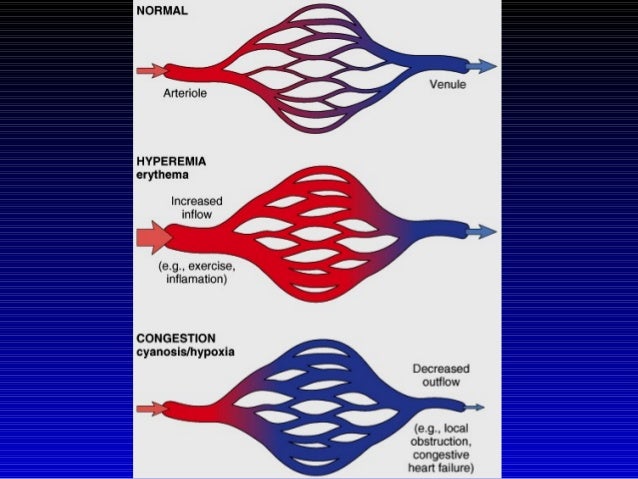 What Causes Reactive Hyperemia To Increase Tissue Perfusion? 2 hyperemia-congestion