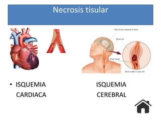 Necrosis tisular
• ISQUEMIA ISQUEMIA
CARDIACA CEREBRAL
 