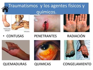 Traumatismos y los agentes físicos y
químicos.
• CONTUSAS PENETRANTES RADIACIÓN
QUEMADURAS QUIMICAS CONGELAMIENTO
 