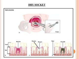 DRY SOCKET
 