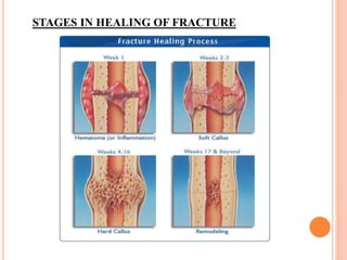 STAGES IN HEALING OF FRACTURE
 
