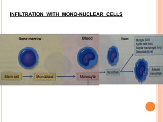 INFILTRATION WITH MONO-NUCLEAR CELLS
 