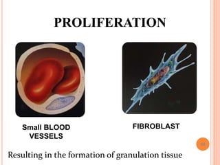 58
PROLIFERATION
Small BLOOD
VESSELS
FIBROBLAST
Resulting in the formation of granulation tissue
 