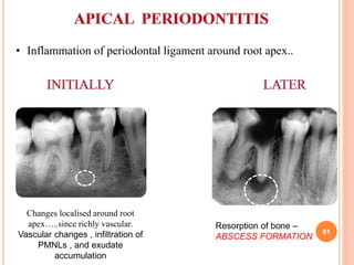 • Inflammation of periodontal ligament around root apex..
Changes localised around root
apex…..since richly vascular.
Vascular changes , infiltration of
PMNLs , and exudate
accumulation
Resorption of bone –
ABSCESS FORMATION
61
 
