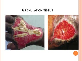 GRANULATION TISSUE
 