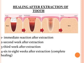 HEALING AFTER EXTRACTION OF
TOOTH
1- immediate reaction after extraction
2-second week after extraction
3-third week after extraction
4-six to eight weeks after extraction (complete
healing)
 