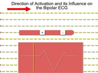 Direction of Activation and its Influence on
                      the Bipolar ECG
+– – – – – – – – – – – – – – – – – – – – – – – –
+– – – – – – – – – – – – – – – – – – – – – – – –
+– – – – – – – – – – – – – – – – – – – – – – – –
+– – – – – – – – – – + – – – – – – – – – – – – –
                     –         -

+– – – – – – – – – – – – – – – – – – – – – – – –
+– – – – – – – – – – – – – – – – – – – – – – – –
+– – – – – – – – – – – – – – – – – – – – – – – –
+– – – – – – – – – – – – – – – – – – – – – – – –
+– – – – – – – – – – – – – – – – – – – – – – – –
+– – – – – – – – – – – – – – – – – – – – – – – –
   10
 