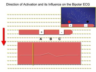 Direction of Activation and its Influence on the Bipolar ECG


   –––––––––––––––––––––––––––––––––––
   –––––––––––––––––––––––––––––––––––
   –––––––––––––––––––––––––––––––––––
   –––––––––––––––––––––––––––––––––––
   –––––––––––––––––––––––––––––––––––
   – – – – – – – – – – – – – – + – – – – – – – –- – – – – – – – – – – – –
                               –
   –––––––––––––––––––––––––––––––––––
                              A       B       C
   –––––––––––––––––––––––––––––––––––
   –––––––––––––––––––––––––––––––––––
   –––––––––––––––––––––––––––––––––––
   –––––––––––––––––––––––––––––––––––
   –––––––––––––––––––––––––––––––––––
   –––––––––––––––––––––––––––––––––––
   –––––––––––––––––––––––––––––––––––
12 – – – – – – – – – – – – – – – – – – – – – – – – – – – – – – – – – – –
 