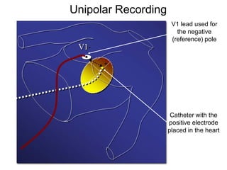 Unipolar Recording
                          V1 lead used for
                            the negative
                          (reference) pole
       -

           +




                          Catheter with the
                         positive electrode
                         placed in the heart



2
 