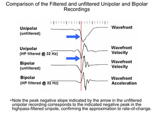 Comparison of the Filtered and unfiltered Unipolar and Bipolar
                         Recordings




  • Note the peak negative slope indicated by the arrow in the unfiltered
    unipolar recording corresponds to the indicated negative peak in the
21 highpass-filtered unipole, confirming the approximation to rate-of-change.
 