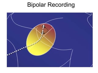 Bipolar Recording




3
 