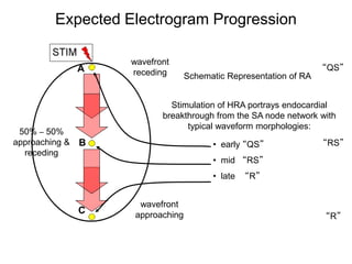 Expected Electrogram Progression

                    wavefront
                A                                                  “QS”
                    receding      Schematic Representation of RA


                             Stimulation of HRA portrays endocardial
                           breakthrough from the SA node network with
                                 typical waveform morphologies:
 50% – 50%
approaching &   B                       • early “QS”               “RS”
  receding
                                        • mid “RS”
                                        • late   “R”


                     wavefront
                C   approaching                                    “R”


38
 