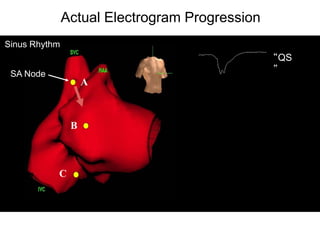 Actual Electrogram Progression
Sinus Rhythm
                                                “QS
 SA Node                                        ”
                    A



                B



           C




 39
 