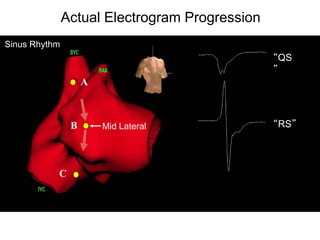 Actual Electrogram Progression
Sinus Rhythm
                                                “QS
                                                ”
                    A



                B       Mid Lateral             “RS”




           C




 40
 