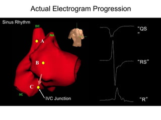 Actual Electrogram Progression
Sinus Rhythm
                                                “QS
                                                ”
                    A



                B                               “RS”




           C

                        IVC Junction            “R”

 41
 