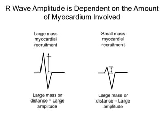 R Wave Amplitude is Dependent on the Amount
         of Myocardium Involved

        Large mass          Small mass
        myocardial          myocardial
        recruitment         recruitment




        Large mass or      Large mass or
       distance = Large   distance = Large
           amplitude          amplitude

42
 