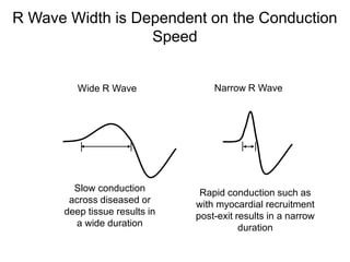 R Wave Width is Dependent on the Conduction
                  Speed


         Wide R Wave               Narrow R Wave




        Slow conduction         Rapid conduction such as
       across diseased or      with myocardial recruitment
      deep tissue results in   post-exit results in a narrow
        a wide duration                   duration

45
 