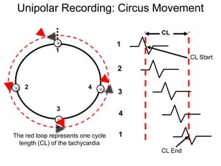 Unipolar Recording: Circus Movement

                                         CL
                                     1
                1
                                                  CL Start
                                     2

      2                    4
                                     3

                3
                                     4

 The red loop represents one cycle   1
   length (CL) of the tachycardia
                                         CL End
46
 