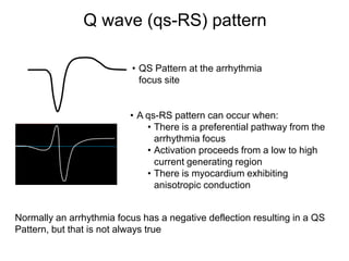 Q wave (qs-RS) pattern

                           • QS Pattern at the arrhythmia
                             focus site


                          • A qs-RS pattern can occur when:
                              • There is a preferential pathway from the
                                arrhythmia focus
                              • Activation proceeds from a low to high
                                current generating region
                              • There is myocardium exhibiting
                                anisotropic conduction


Normally an arrhythmia focus has a negative deflection resulting in a QS
Pattern, but that is not always true
48
 