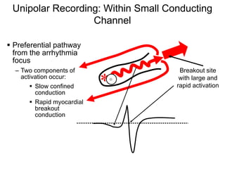Unipolar Recording: Within Small Conducting
                  Channel

 Preferential pathway
  from the arrhythmia
  focus
     – Two components of             Breakout site
       activation occur:
           Slow confined
            conduction
                               *     with large and
                                    rapid activation

           Rapid myocardial
            breakout
            conduction




49
 