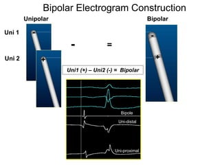 Bipolar Electrogram Construction
        Unipolar                                      Bipolar

Uni 1     -                                            -
                    -              =
Uni 2         +                                            +
                   Uni1 (+) – Uni2 (-) = Bipolar




                                          Bipole

                                        Uni-distal




                                       Uni-proximal
  5
 
