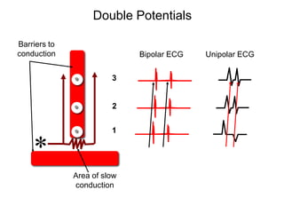 Double Potentials

 Barriers to
 conduction                   Bipolar ECG   Unipolar ECG

                         3


                         2


                         1

     *
               Area of slow
               conduction

53
 