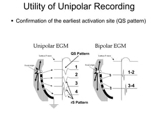 Utility of Unipolar Recording
      Confirmation of the earliest activation site (QS pattern)




                               QS Pattern


                                 1
                                                        1-2
                                 2
                                 3
                                                        3-4
                                 4

                               rS Pattern


59
 
