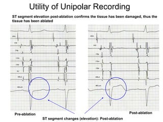 Utility of Unipolar Recording
     ST segment elevation post-ablation confirms the tissue has been damaged, thus the
     tissue has been ablated




      Pre-ablation                                                    Post-ablation
62
                     ST segment changes (elevation): Post-ablation
 