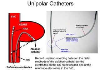 Unipolar Catheters

        SVC


              HEART
                 HRA




                         Ablation
                         catheter

                            Record unipolar recording between the distal
                   IVC
                            electrode of the ablation catheter (or the
                            electrodes on the CS catheter) and one of the
     Reference electrodes   reference electrodes in the IVC
63
 