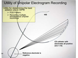 Utility of Unipolar Electrogram Recording
     Utility for determining the best
      ablation site in WPW
           PQS Pattern;
           Recording multiple                     HIS
            simultaneous unipolar
            recordings




                                                         CS catheter with
                                                         electrodes all positive
                                                         (Uni 1-10)



64                        Reference electrode is
     64                   negative
 