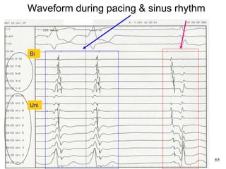 Waveform during pacing & sinus rhythm



     Bi




     Uni




65                                           65
 