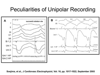 Peculiarities of Unipolar Recording
A                                           B




66 Soejima, et al., J Cardiovasc Electrophysiol, Vol. 16, pp. 1017-1022, September 2005
 