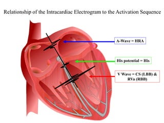 Relationship of the Intracardiac Electrogram to the Activation Sequence




                                                  A-Wave = HRA



                                                   His potential = His


                                                   V Wave = CS (LBB) &
                                                       RVa (RBB)




 69
 