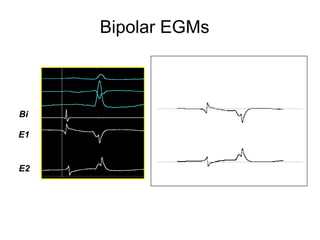 Bipolar EGMs



    Bi

E1


E2




7
 