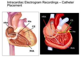 Intracardiac Electrogram Recordings – Catheter
     Placement


                              HRA
                                                CS
                   His
HRA
                         CS

                                                 His




                                                RVA
                    RVA


70
 