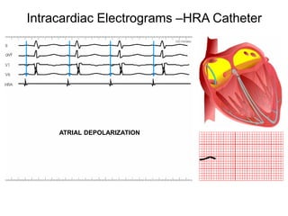 Intracardiac Electrograms –HRA Catheter




          ATRIAL DEPOLARIZATION




72
 