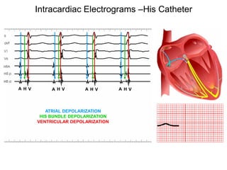 Intracardiac Electrograms –His Catheter




     A HV        A HV        A HV        A HV



               ATRIAL DEPOLARIZATION
             HIS BUNDLE DEPOLARIZATION
            VENTRICULAR DEPOLARIZATION




73
 
