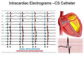 Intracardiac Electrograms –CS Catheter




     A V      A V         A V           A V
              ATRIAL DEPOLARIZATION
           VENTRICULAR DEPOLARIZATION




74
 