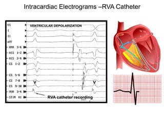 Intracardiac Electrograms –RVA Catheter

       VENTRICULAR DEPOLARIZATION




        V                               V


               RVA catheter recording



77
 