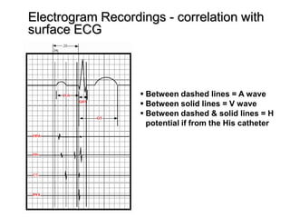 Electrogram Recordings - correlation with
     surface ECG



                         Between dashed lines = A wave
                         Between solid lines = V wave
                         Between dashed & solid lines = H
                          potential if from the His catheter




79
 
